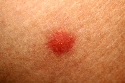 ᑕ ᑐ Milbenbisse - Milbenstiche    Erkennen & behandeln